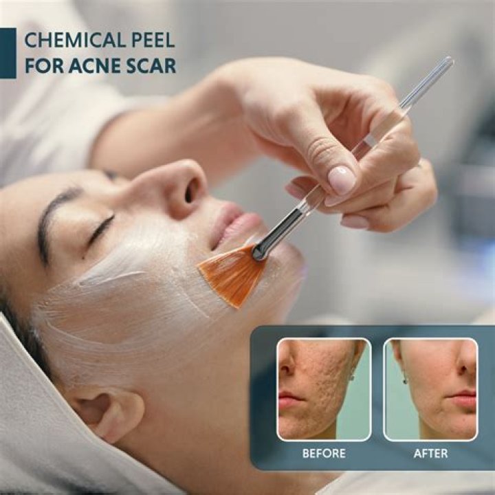 8 Best Chemical Peels for Acne Scars for an Even Tone And Texture