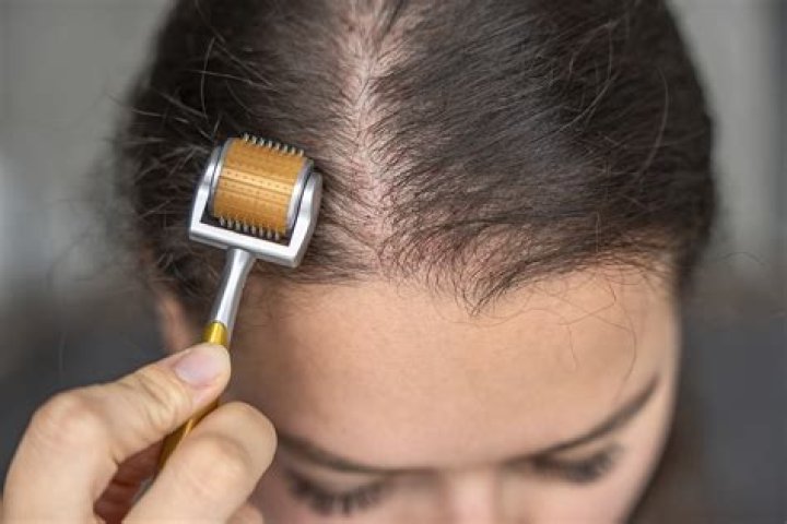 8 Best Derma Rollers for Hair Growth for Long, Lustrous Mane
