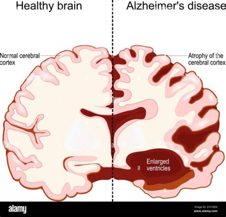 Alzheimer's Collateral Damage | Dementia Support Forum