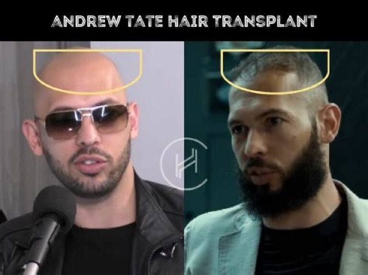 Andrew Tate: Hair Transplant Rumours, Bio, Fame, Controversy, Arrest and More