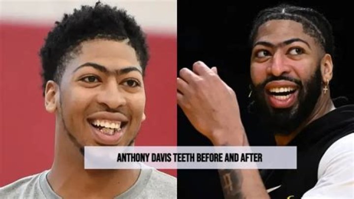 Anthony Davis Teeth Then And Now- Photos Before & After