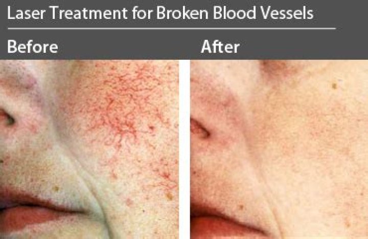 Broken Blood Vessels on Face: Causes and Treatments
