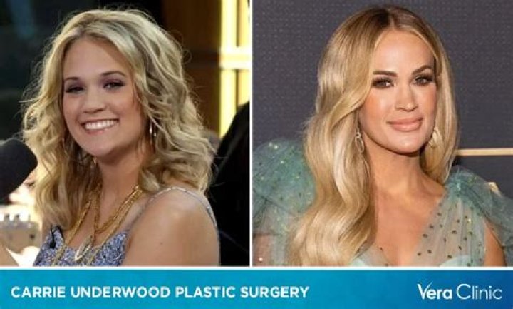 Carrie Underwood Plastic Surgery: Before And After Looks