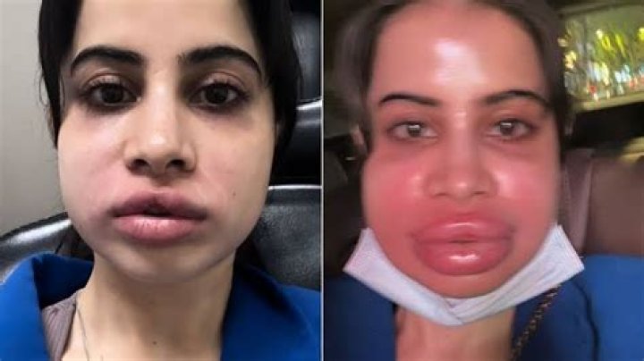 Did Urfi Javed Undergone Plastic Surgery? Before And After – Lip Fillers Images Explored