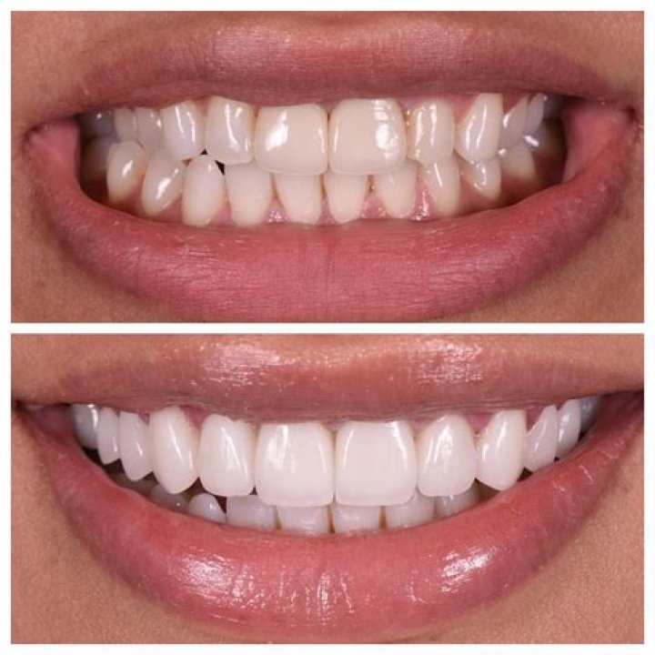 Dr. Apa Is The Dentist Behind Instagram's Most Natural Veneers