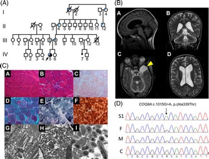 Early-onset coenzyme Q10 deficiency associated with ataxia and respiratory chain dysfunction due to novel pathogenic COQ8A variants, including a large intragenic deletion - ePrints