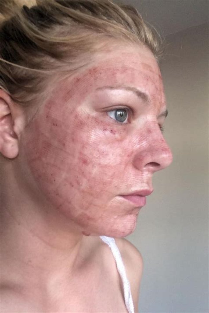 Facial laser to freshen my skin ruined my life after burning my face – The Sun