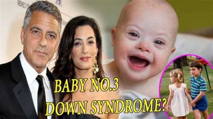 George Clooney Twins Have Down Syndrome: Understanding The Journey