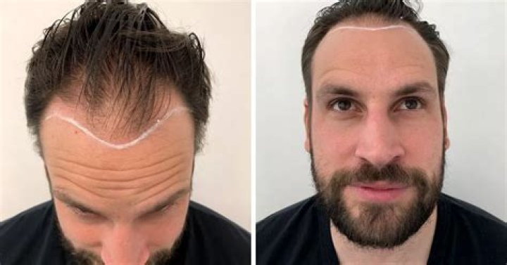 Has He Undergone Hair Replacement Treatment?