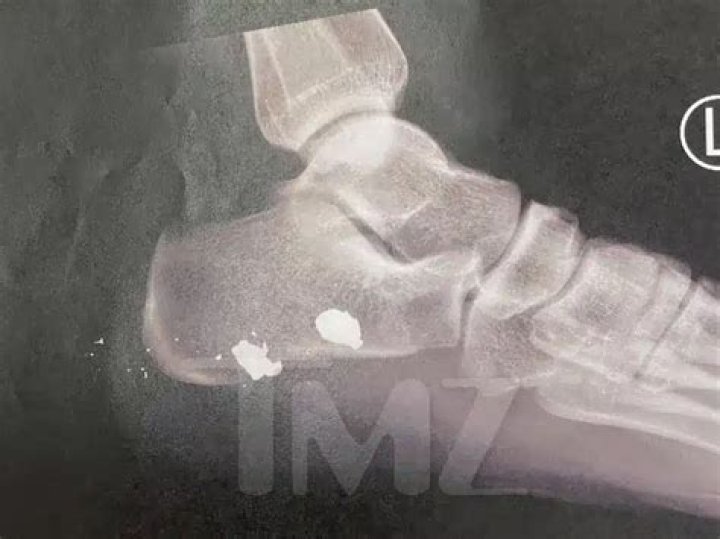 Here's Megan Thee Stallion Foot X-Rays After Tory Lanez Shooting