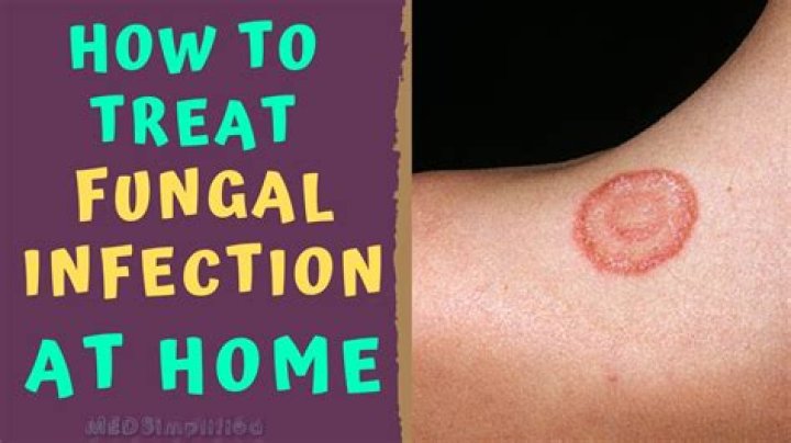 How to Treat a Skin Infection