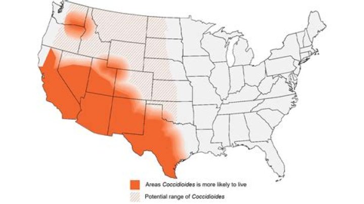 How to Treat Valley Fever