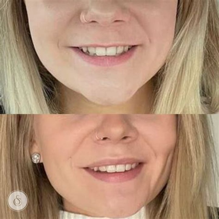 I spent £24 on a budget lip flip… people say I should have spent loads more but expensive isn’t always better