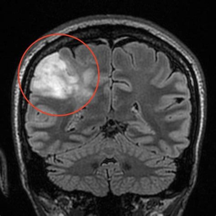 Is She Suffering From A Brain Tumor?