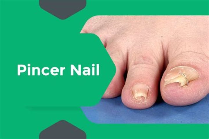 Is there a cure for pincer nails