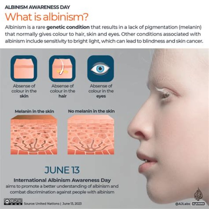 Is there research being done on albinism