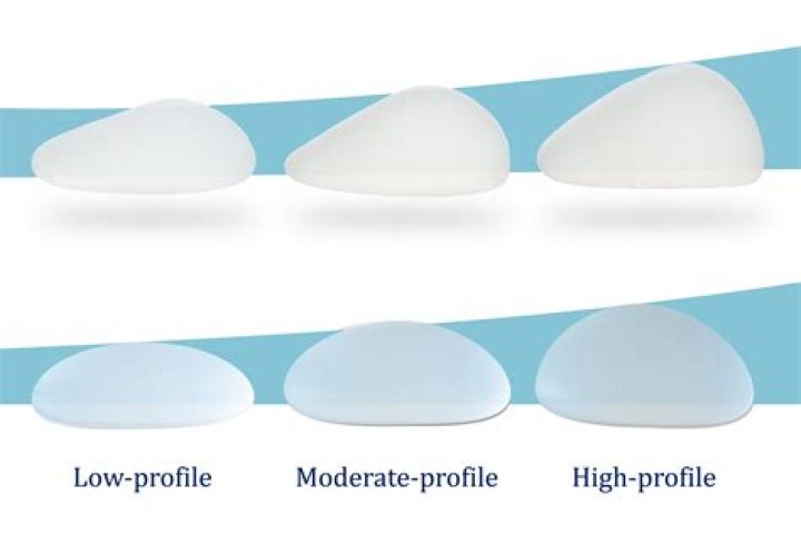 Kendall Toole Breast Implants: A Comprehensive Overview