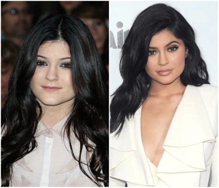 Kylie Jenner Avant Chirurgie: 