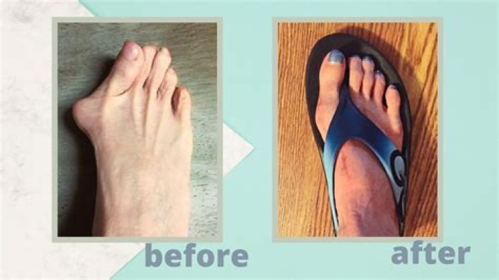 Lapiplasty Bunion Surgery: Amazing Before and After Photos