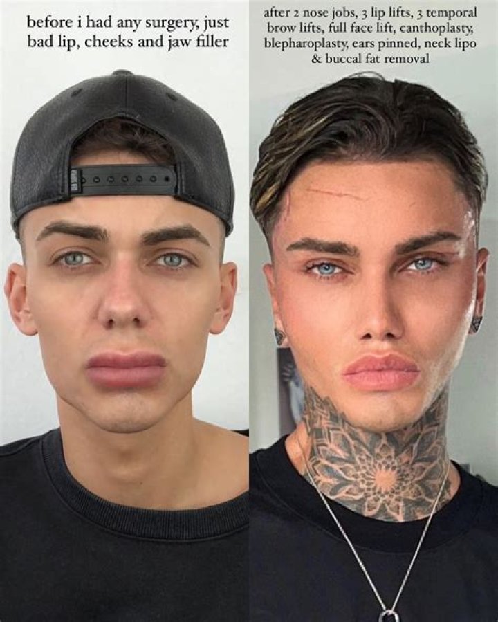 Levi Jed Murphy’s Before And After Looks: TikTok Star Underwent Plastic Surgery And Came Up With A Drastic Difference In Appearance