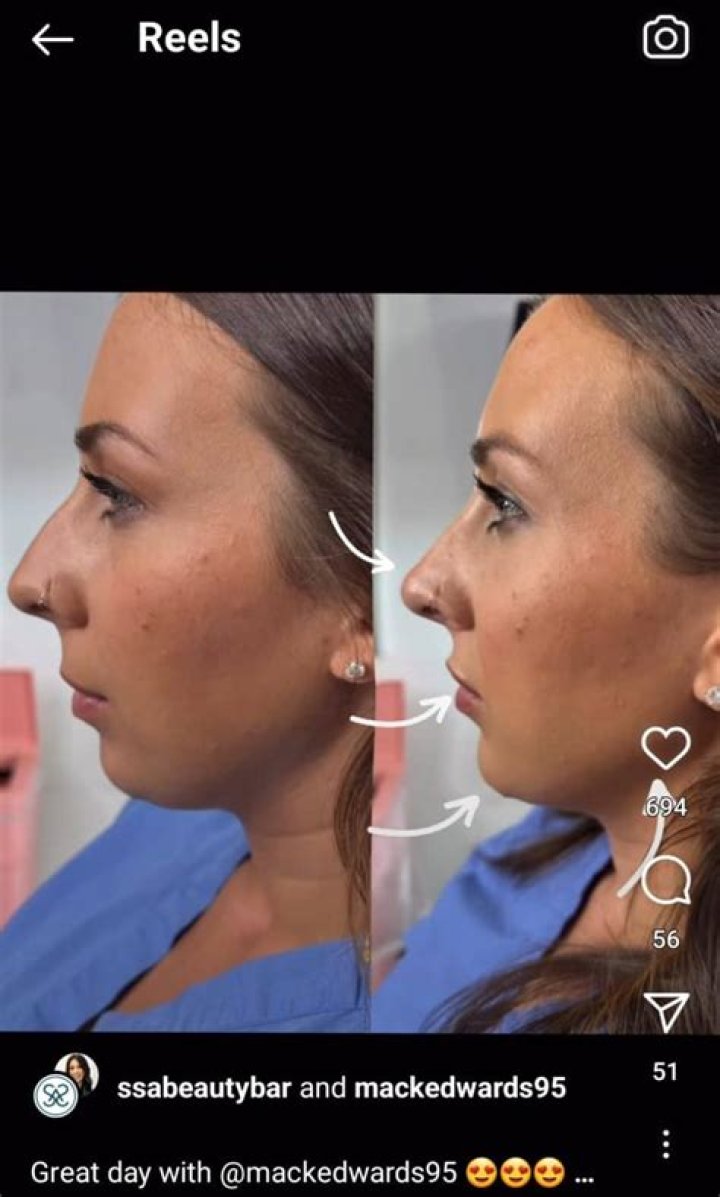 Mackenzie Edwards undergoes cosmetic work to feel her ‘best confident self’ — See the Teen Mom alum’s results