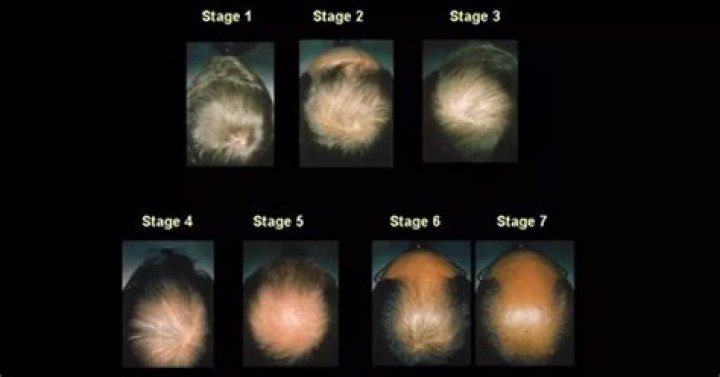 Male Pattern Baldness: Everything You Need To Know