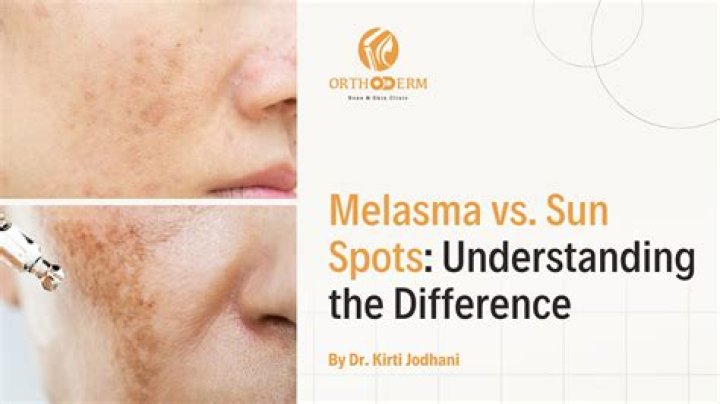 Melasma: A Pervasive Challenge in India's Dermatological Landscape