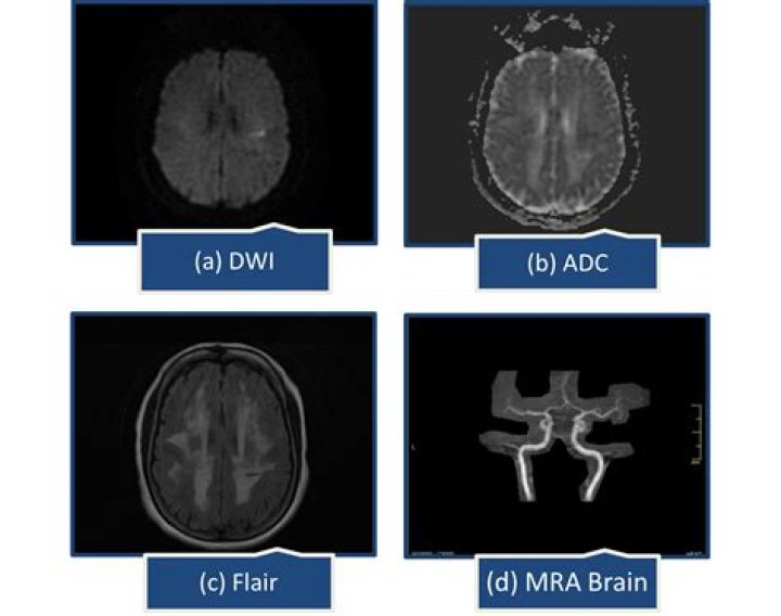 Microvascular pathology in familial multi-infarct dementia or CADASIL: implications for cerebral blood flow. - ePrints