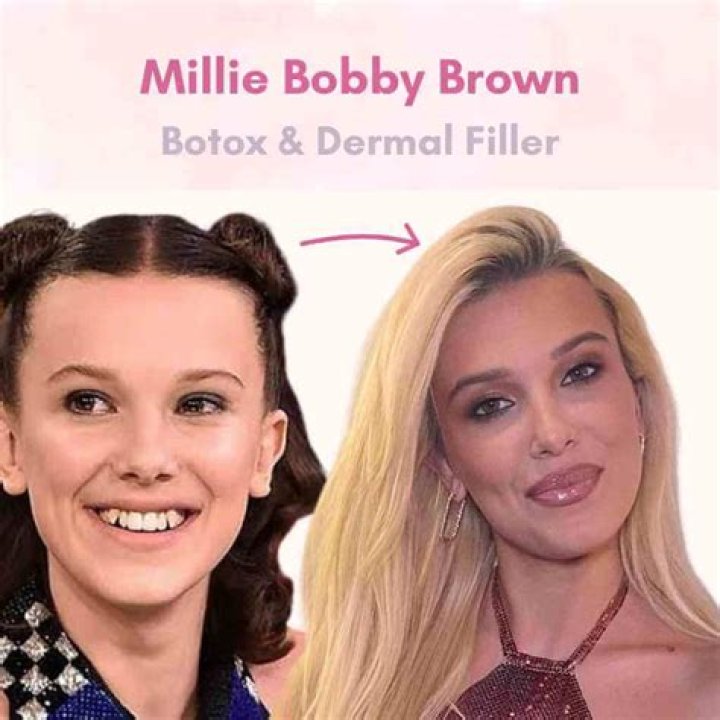 Millie Bobby Brown And The Botox Controversy: What You Need To Know