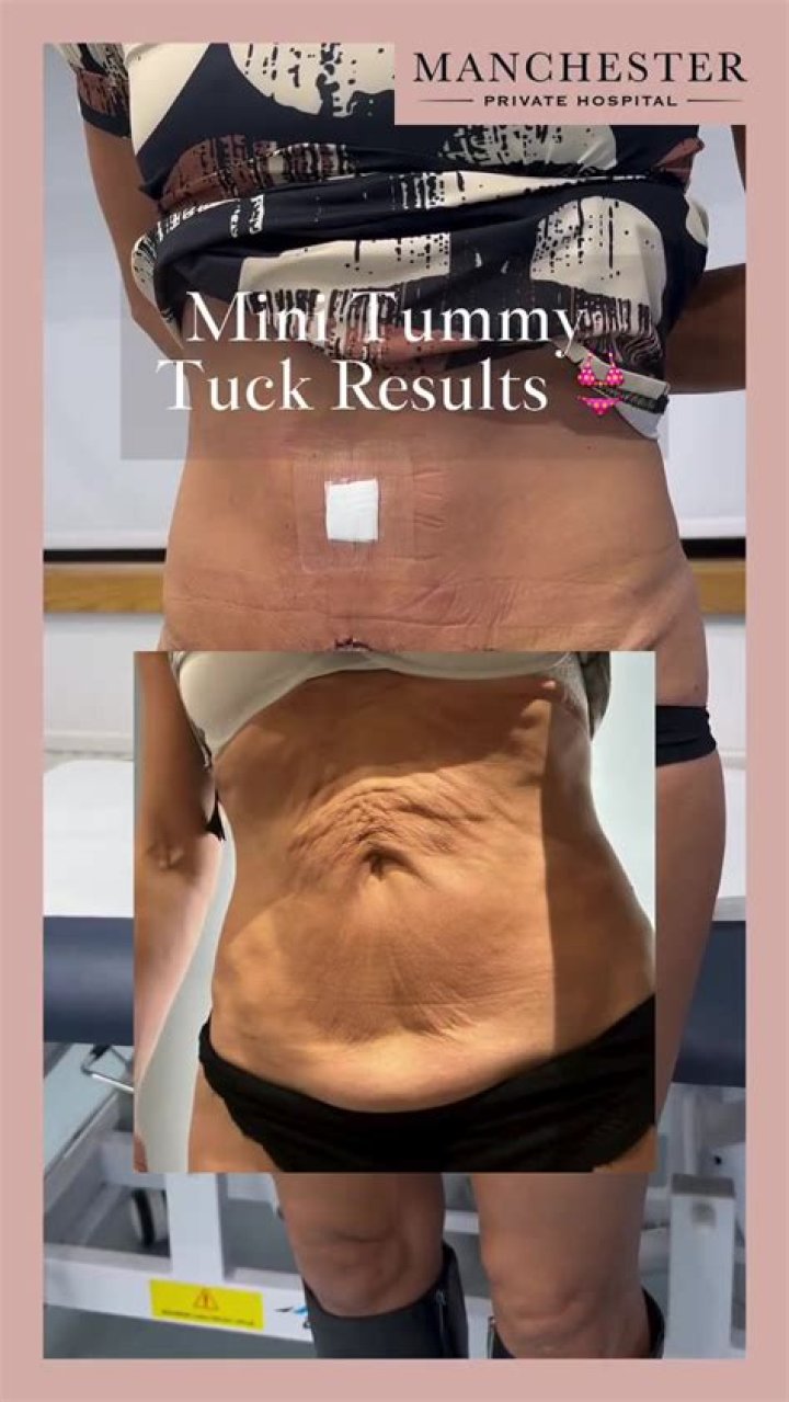 Mini Tummy Tuck Before and After: See The Dramatic Results