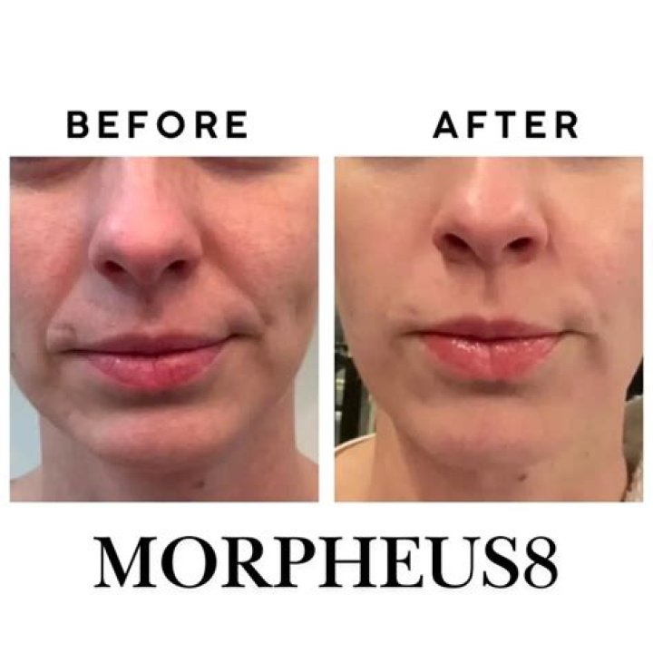 Morpheus8 Before and After: One Woman's Amazing Story
