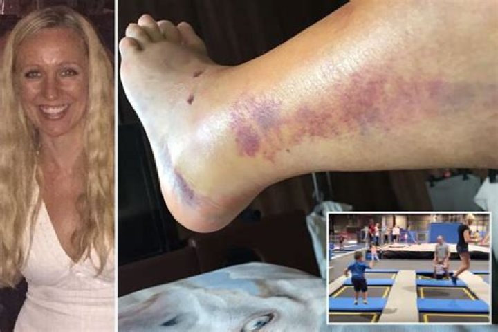 Mum-of-six blacked out after breaking her leg at trampoline park and claims staff joked 'she was on drugs' when she came round