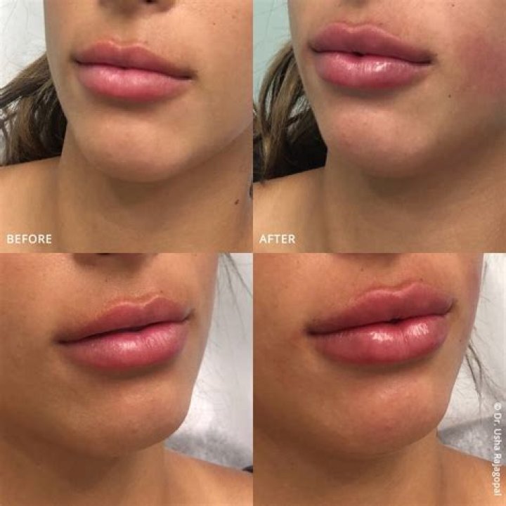My lip filler was a huge fail - before and afters of my pout make me cringe, my face went massive too