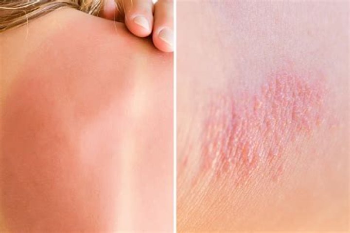 Plagued by a summer rash? How to tell if it’s heat rash or something more sinister