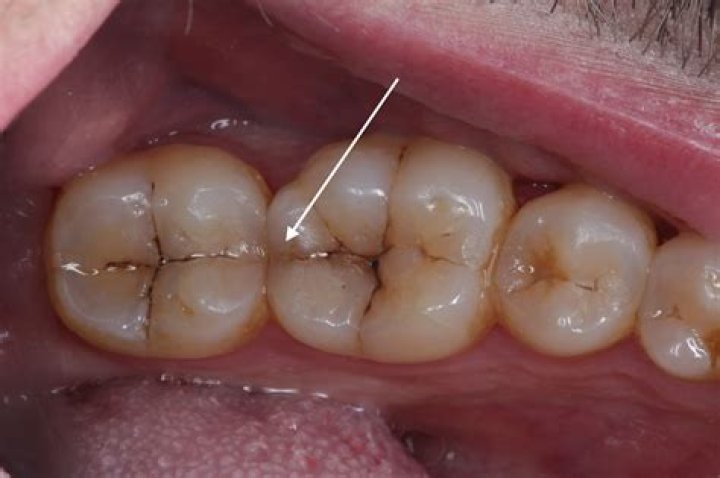 Some of my Mum's teeth have gone black