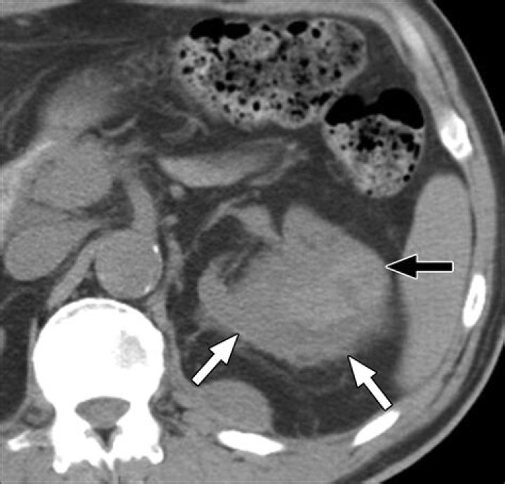 Spontaneous Abdominal Hemorrhage with AA-amyloidosis and Vasculitis in a Patient with Rheumatoid Arthritis - ePrints