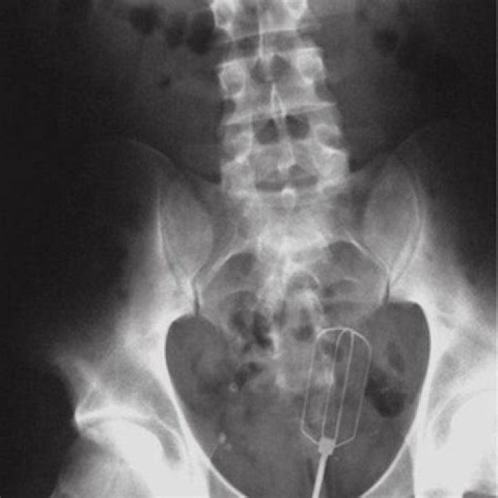 	‘Stuck Up!’ Odd Objects Inserted in Odder Places	