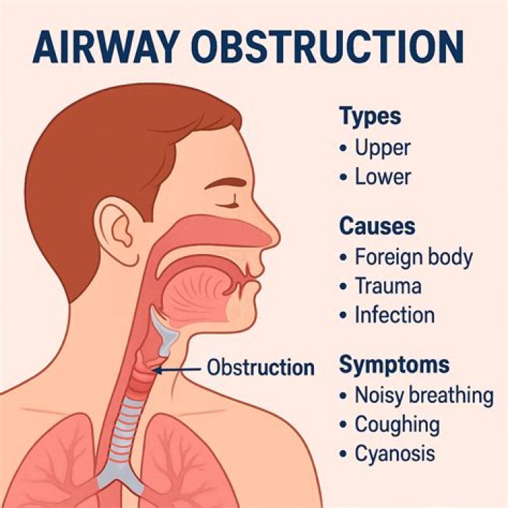 The effect of scuba diving on airflow obstruction in divers with asthma - ePrints