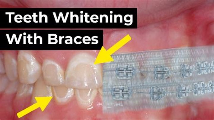 What Happened To Bryce Young Teeth? Has He Used Braces And Whitened?