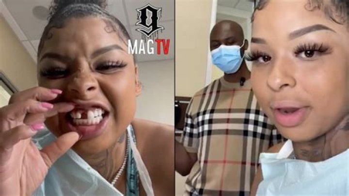 What Happened To Chrisean Rock Tooth?