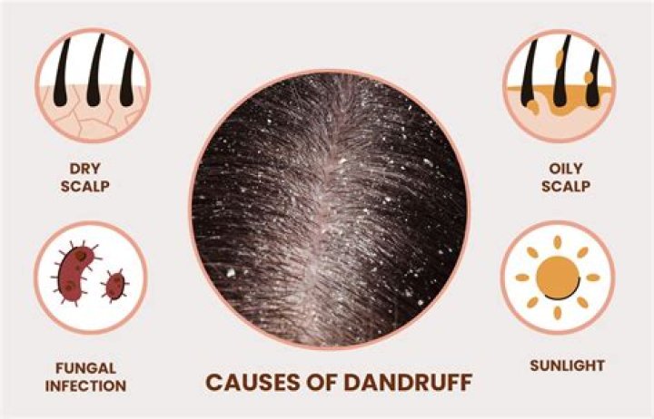 What Is Wet Dandruff? Here’s a Breakdown of Its Causes, Treatment, And Prevention