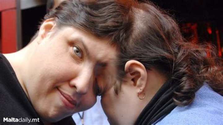 Who Were Lori And George Schappell? Know About World's Oldest Conjoined Twins As They Pass Away At 62