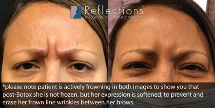 Why is my frown uneven after Botox?