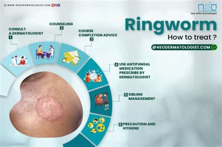 Will sunlight help ringworm?