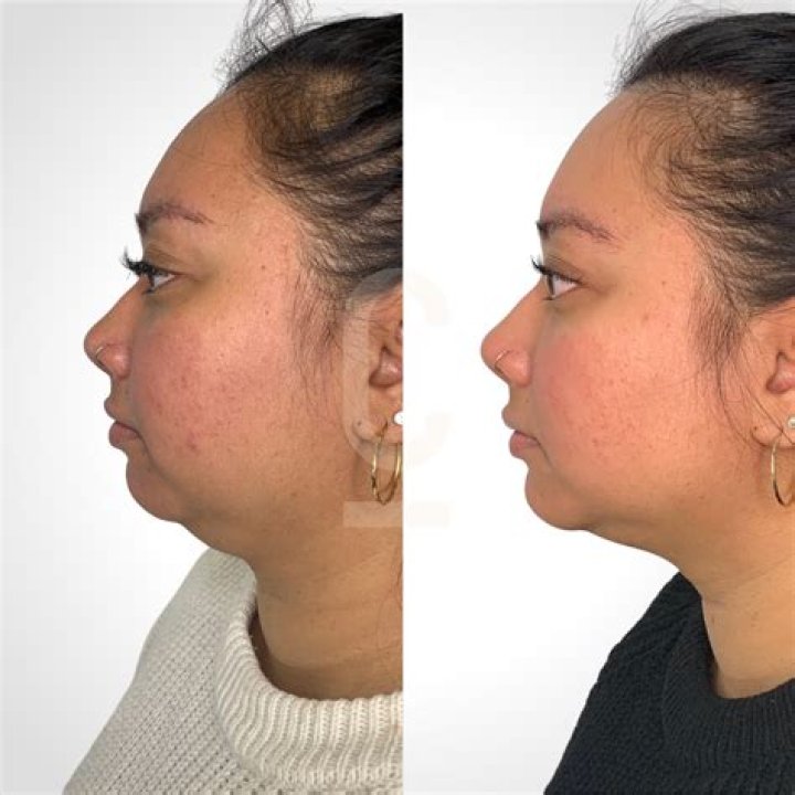 Woman blows people away as she shows the incredible before and afters of her double chin fat dissolving injections